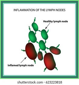 Inflammation Lymph Nodes Infographics Illustration On Stock 