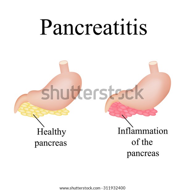 Inflammation Pancreas Pancreatitis Illustration On Isolated Stock ...