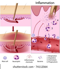Inflammation response (host defense mechanism)