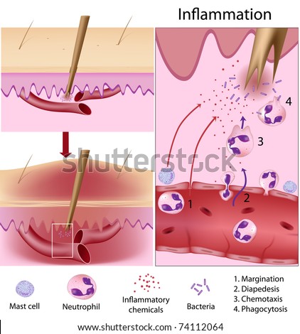 inflammation response host defense mechanismのイラスト素材 74112064