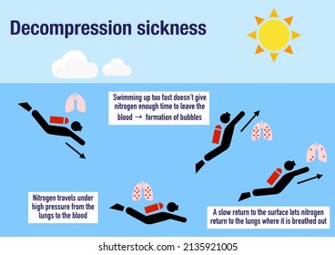 Infographic Explaining The Decompression Sickness Or Divers Disease