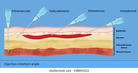 347 Tuberculin Images, Stock Photos & Vectors | Shutterstock