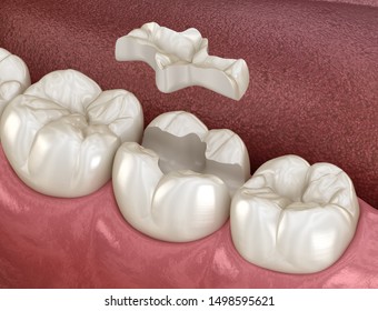 Inlay Ceramic Crown Fixation Over Tooth. Medically Accurate 3D Illustration Of Human Teeth Treatment