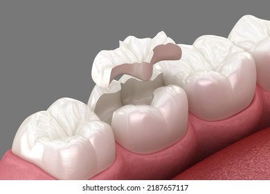 Inlay Ceramic Crown Placement. Medically Accurate 3D Illustration Of Human Teeth Treatment