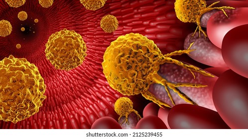 Inner Intestine Cancer Anatomy Concept As The Malignant Tumor Growth Inside Of A Digestion Organ With Intestinal Villi And Crypts In A 3D Illustration Style.