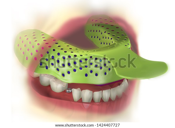 Insert Dental Impression Tray Into Patients のイラスト素材