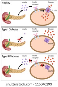 Insulin action and diabetes type 1 and 2