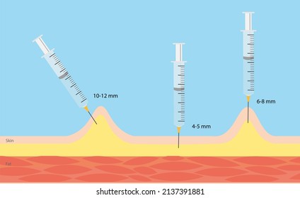 Insulin Injection Technique. Syringe Size And Angle Injection Technique. 