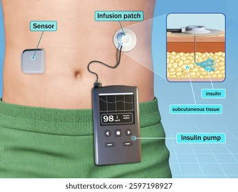 Insulin pump and wireless glucose sensor for diabetic patients. Digital illustration, 3d render.