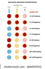 Interpretation of ABO Blood Grouping. Laboratory technique to interpret our blood group with anti-A, Anti-B and Anti-D.