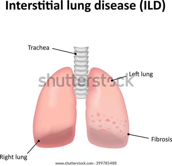 Interstitial Lung Disease Labeled Stock Illustration 399785488