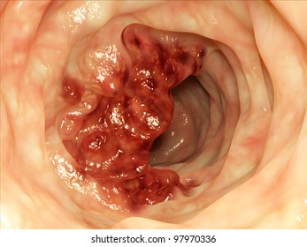 Intestine Tumor