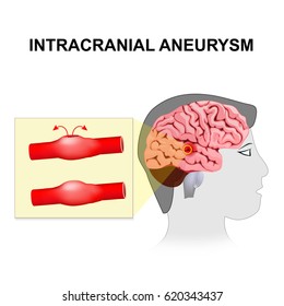 207 Intracranial hemorrhage Images, Stock Photos & Vectors | Shutterstock