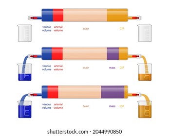 intracranial pressure and cerebral haemodynamics, The Monro-Kellie Doctrine Regarding Intracranial Compensation for Expanding Mass, 2d graphic, illustration - Powered by Shutterstock