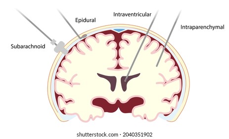 Intracranial Pressure Monitoring (ICP) Monitoring Device Placement In A Coronal Section.