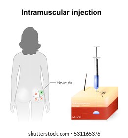 Intramuscular Injection Angle Depth Injections Technique: стоковая ...