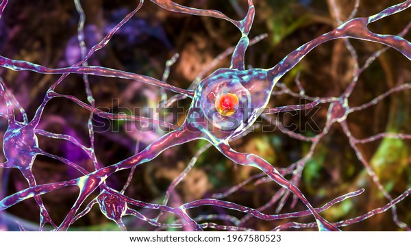 Intranuclear inclusion in neurons of Dorsal\
striatum, 3D illustration. Dorsal striatum is a nucleus in the\
brain basal ganglia, inclusions and neuron degradation are found in\
Huntingon\'s\
disease
