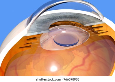 Intraocular Lens Implanted In The Human Eye, Cataract Extraction Surgery, 3D Rendering, 4K Video Available, Clip Id 1006594357.