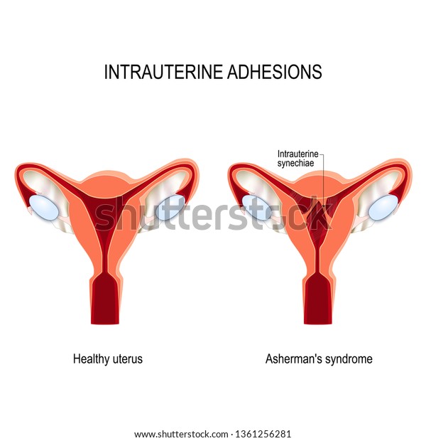 intrauterine adhesions. Asherman's syndrome. scar
tissue form inside the uterus or cervix. front and back walls of
the uterus stick to one
another