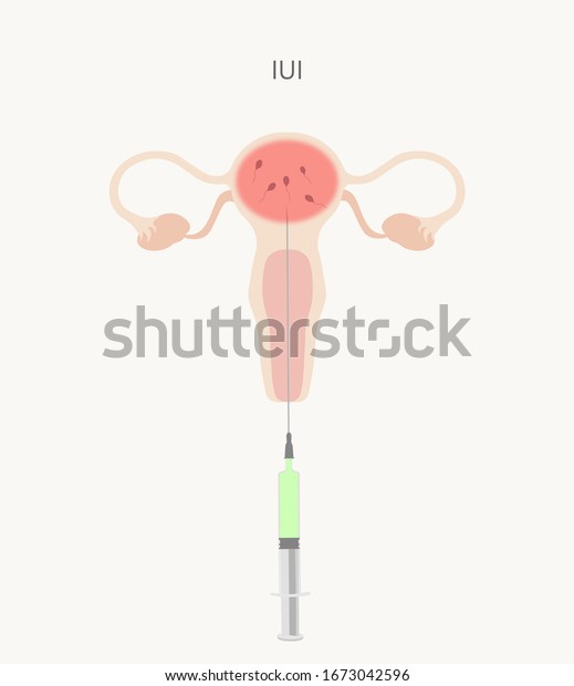 Intrauterine Insemination Iui Pregnancy Method Medical Stock ...