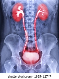 Intravenous Pyelogram Or I.V.P Showing  Of Urinary Tract After Injection Contrast Media Agent 25 Minute.