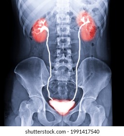  Intravenous pyelogram or I.V.P is an X-ray exam of urinary tract after injection contrast media agent 20 minute.