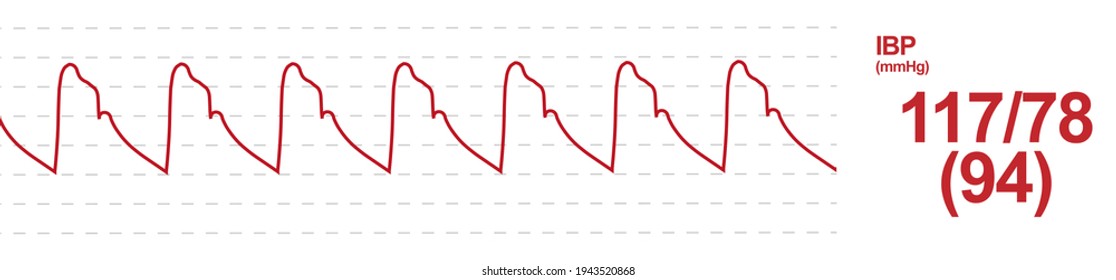 Invasive Blood Pressure(IBP) Monitoring Screen. Arterial Pulse Waveform Monitor. 	