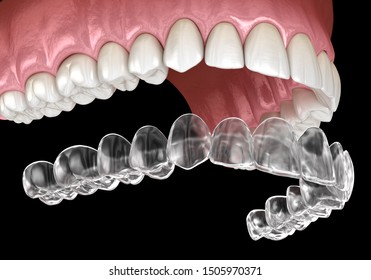 Invisalign Braces Or Invisible Retainer. Medically Accurate Dental 3D Illustration