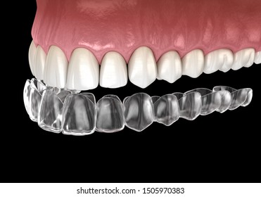 Invisalign Braces Or Invisible Retainer. Medically Accurate Dental 3D Illustration