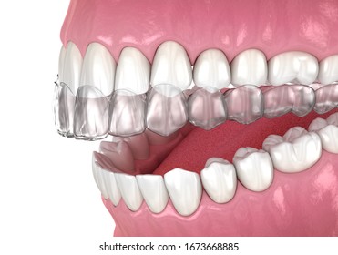 Invisalign Braces Or Invisible Retainer. Medically Accurate Dental 3D Illustration