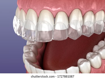 Invisalign Braces Or Invisible Retainer. Medically Accurate Dental 3D Illustration