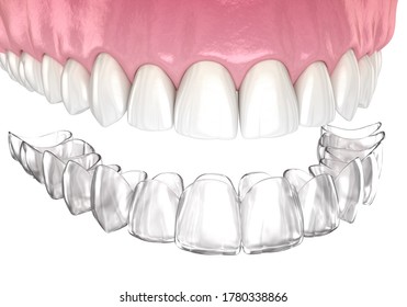 2,536 Invisalign isolated Images, Stock Photos & Vectors | Shutterstock