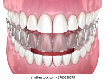 Invisalign Braces Or Invisible Retainer. Medically Accurate Dental 3D Illustration