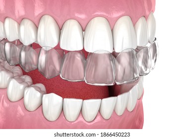 Invisalign Braces Or Invisible Retainer. Medically Accurate Dental 3D Illustration