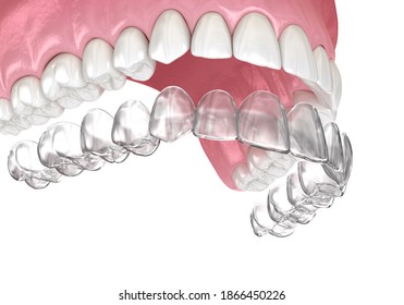 Invisalign Braces Or Invisible Retainer. Medically Accurate Dental 3D Illustration