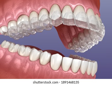 Invisalign Braces Or Invisible Retainer. Medically Accurate Dental 3D Illustration