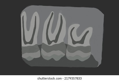 Iopa Xray Animated Picture Of Maxillary Molars