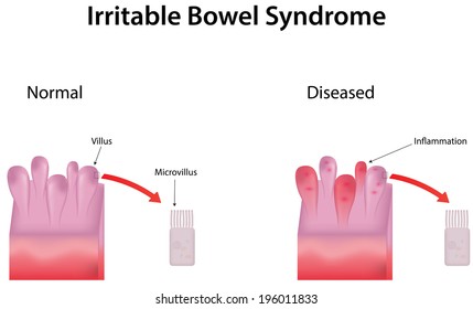 Irritable Bowel Syndrome