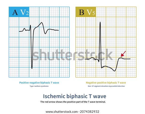 Ischemic Biphasic T Wave Can Show Stock Illustration 2074382932 ...