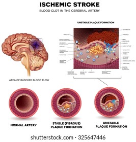 Ischemic Stroke In The Cerebral Artery. Stable And Unstable Plaque Formation And Thrombus.