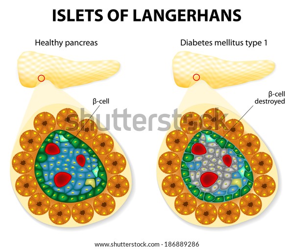 diabetes langerhans
