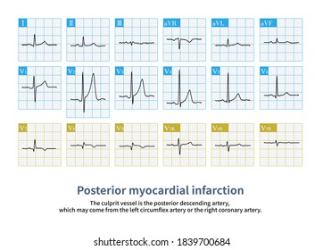 894 Chest leads Images, Stock Photos & Vectors | Shutterstock