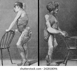 Joseph Merrick (1862-1890), 'Elephant Man', Suffered From Neurofibromatosis, A Congenital Disorder. Standing Profile Engravings Of Merrick Were Published In British Medical Journal In 1886.