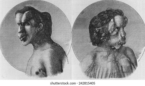 Joseph Merrick (1862-1890), Known As The 'Elephant Man', Suffered From Neurofibromatosis, A Congenital Disorder. Bust Portrait Engravings Of Merrick Were Published In British Medical Journal In 1886.