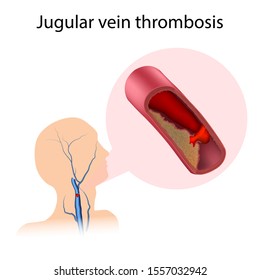 Jugular Vein Thrombosis. Blood Clot Blocks The Vessel. Medical Illustration.