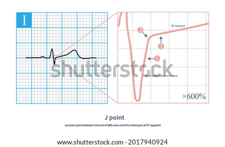 The junction between the end of QRS wave and the beginning of ST segment is called J point, which is the turning point of ventricular depolarization and repolarization.