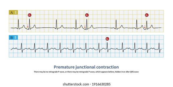 199 Limb Muscle Contraction Images, Stock Photos & Vectors | Shutterstock