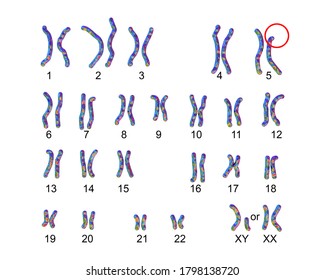 Karyotype of Cri du chat, or cat's cry, syndrome, labelled 3D illustration. A rare genetic disorder caused by a partial chromosome deletion on chromosome 5. Also known as 5p- and Lejeune's syndrome