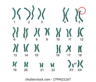 Karyotype Cri Du Chat Cats Cry Stock Illustration 1799621167 | Shutterstock