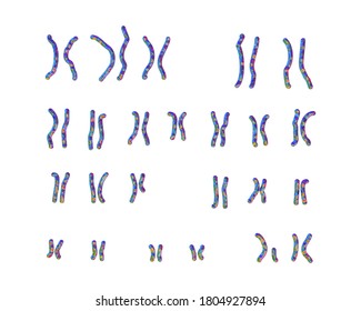 Karyotype of Prader-Willi syndrome, 3D illustration. A genetic disorder caused by a lack of function of part of chromosome 15 inherited from a person's father
